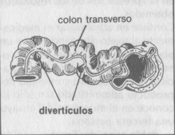 diverticulosis