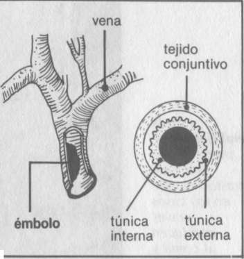 embolia