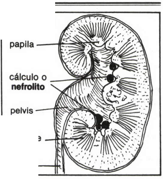 Imagen de nefrolitiasis numero 1