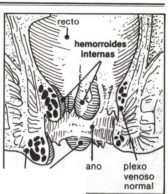 Imagen de Hemorroidal numero 1